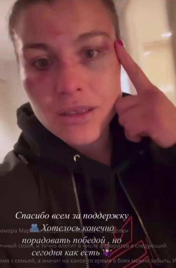 «Макияж на недельку». Жена бойца UFC показала гематомы на лице